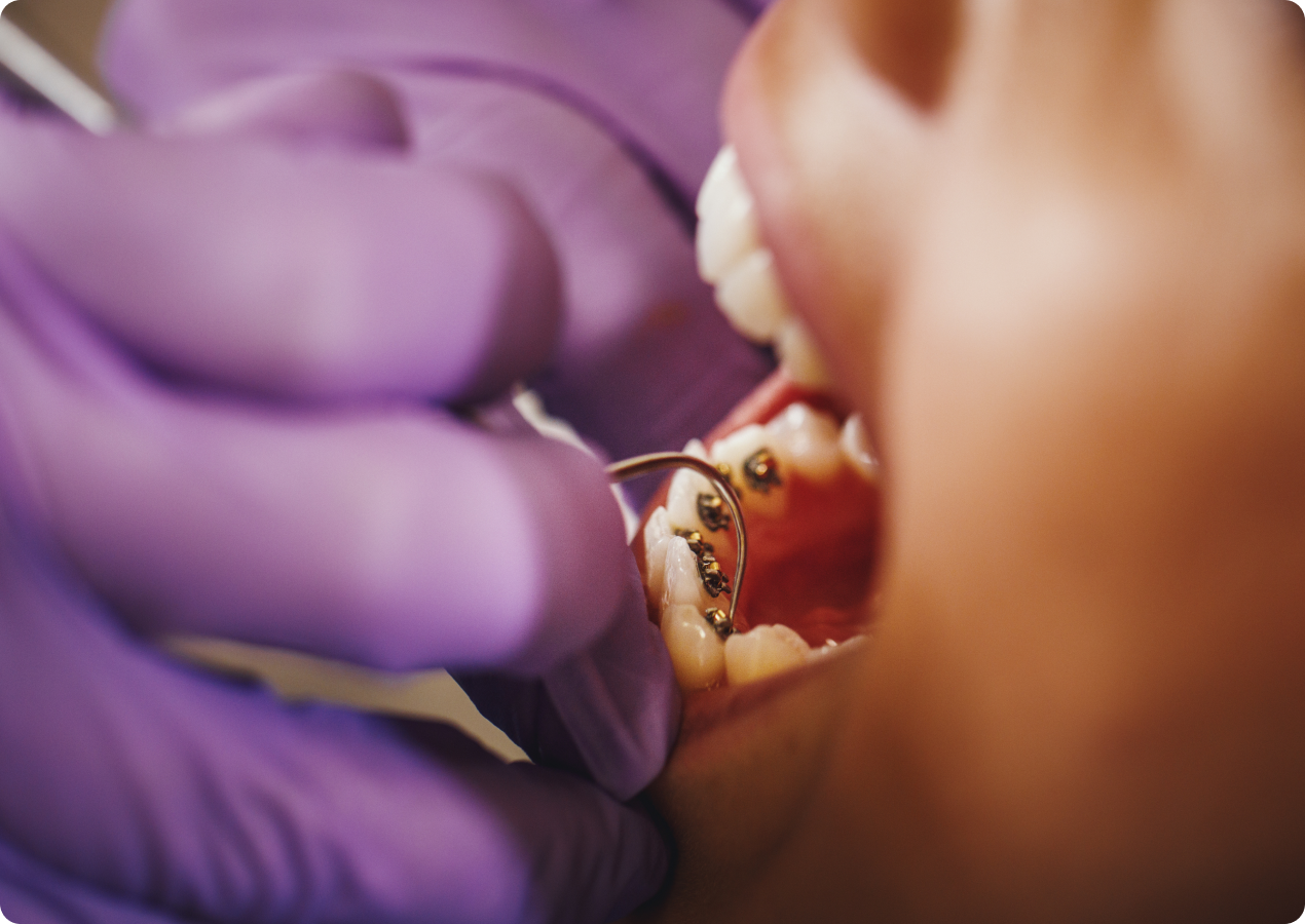 Mains gantées examinant la bouche d'un patient avec un instrument dentaire