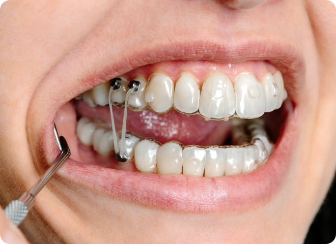 Gros plan sur des dents équipées de bagues dentaires