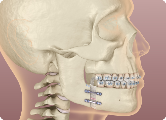 Représentation de plaques de fixation sur une mâchoire après chirurgie