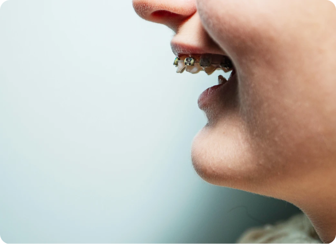 Profil d'une bouche portant des bagues dentaires
